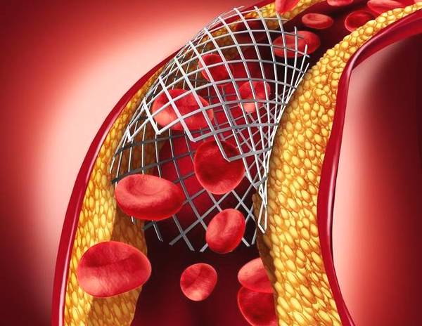 【力美新材料】生物可吸收支架獲批，近百萬冠心病患者或因此受益